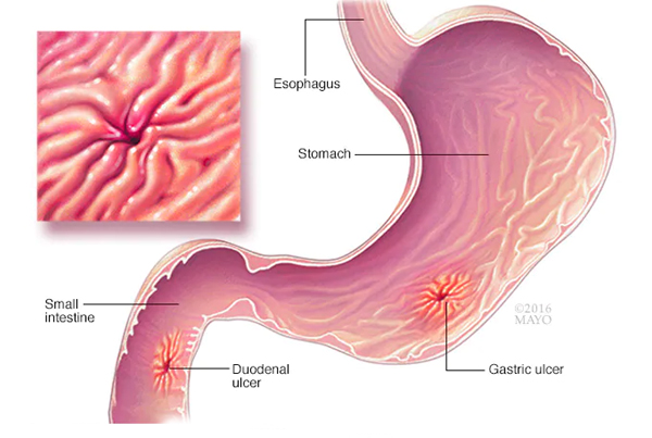 H Pylori
