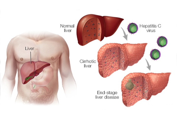 Hepatitis