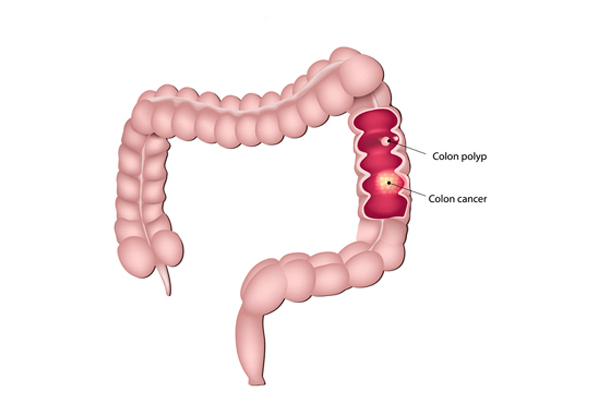 Colonic Polyps