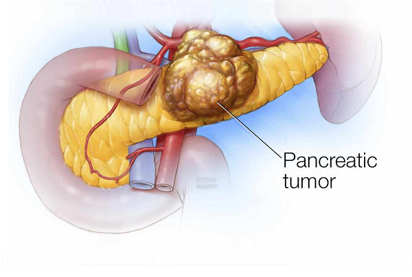 Pancreatic Cancer