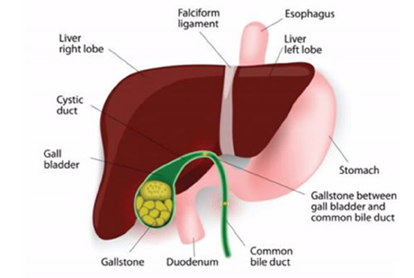 Gallbladder Stones