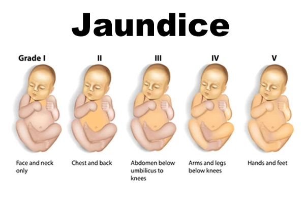 Jaundice