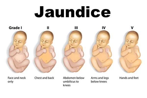 Jaundice