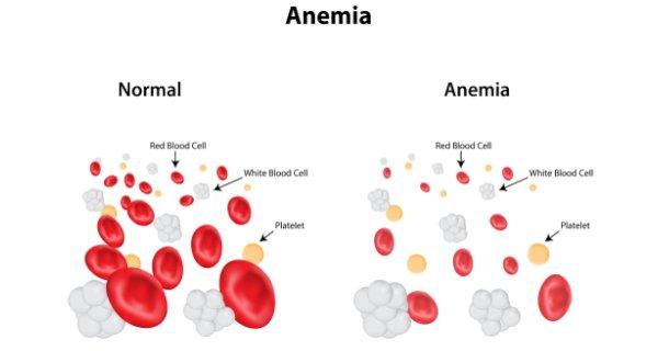 Anemia