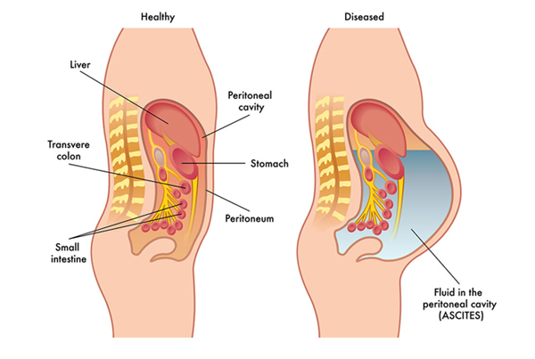 Ascites