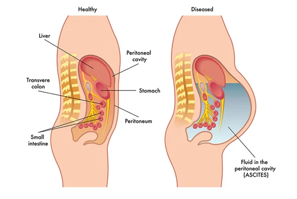 Ascites